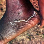 Having spent a year or more developing in its human host's body, this parasitic guinea worm (Dracunculus medinensis) emerges from its host's foot. This worm can grow up to 3 feet long. Attempts to eradicate this parasite seem to be proceeding well. Ibadan area, 1967.